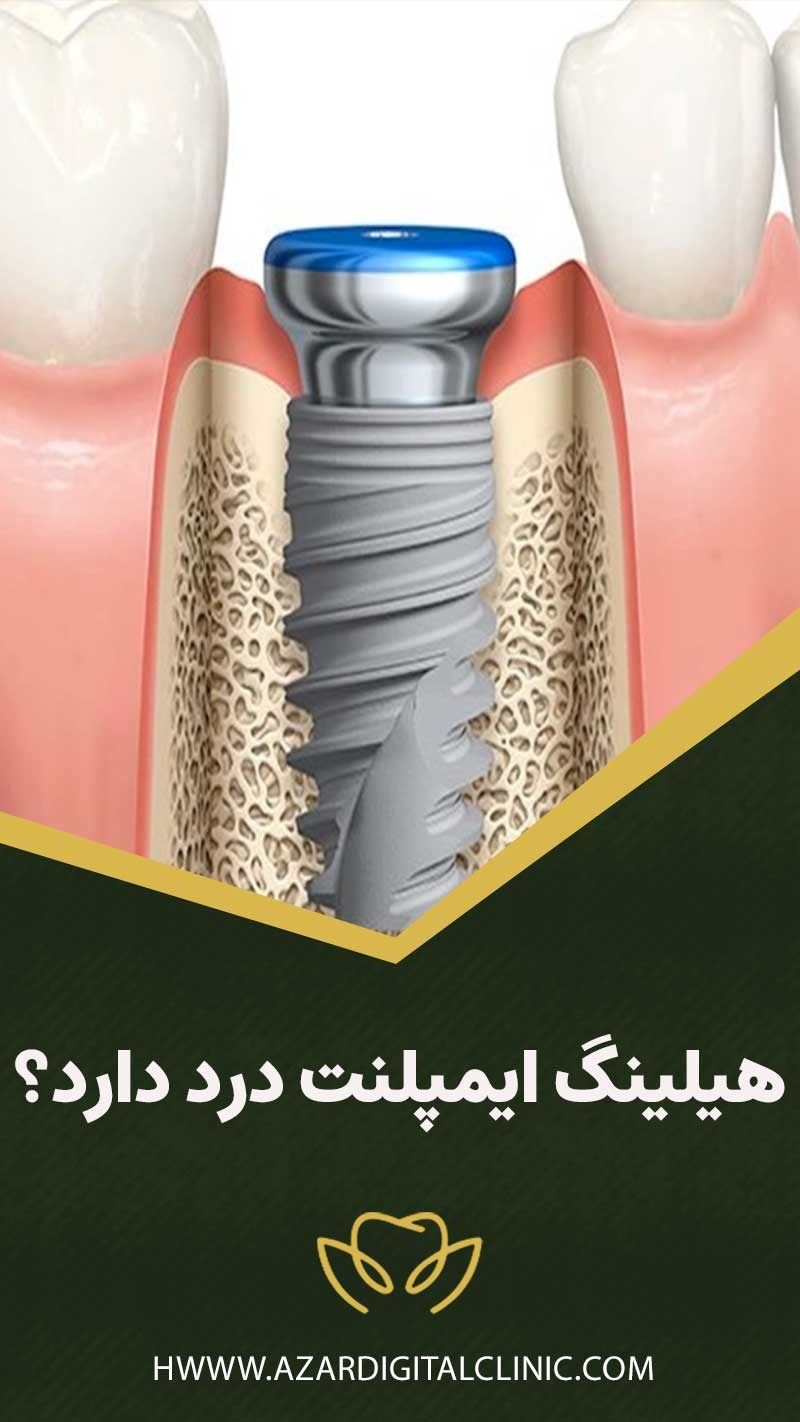 آیا بستن، نصب یا گذاشتن هیلینگ ایمپلنت درد دارد؟