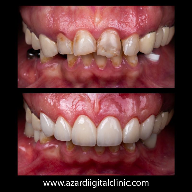 نمونه درمان لمینیت سرامیکی در اصفهان در مرکز دندانپزشکی دیجیتال آذر در اصفهان